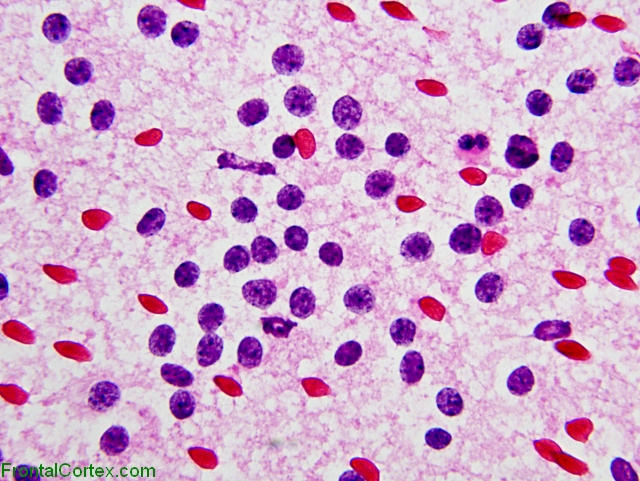 Central neurocytoma,   Intraoperative smear preparation x 400